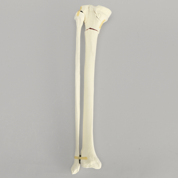 Tibia with Bicondylar and Transverse Fractures and Intact Fibula