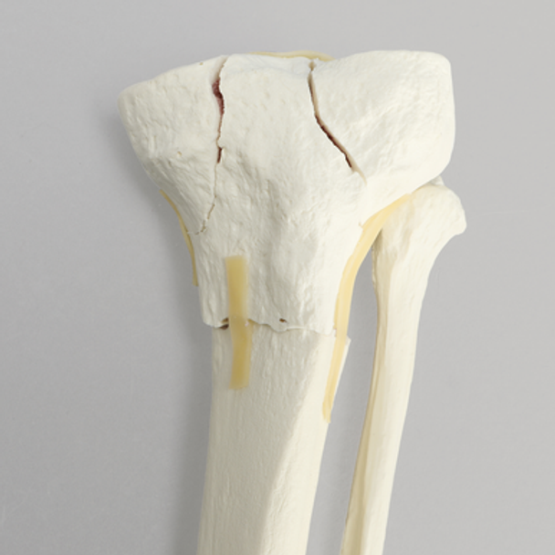 Tibia with Bicondylar and Transverse Fractures and Intact Fibula