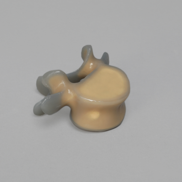 Lumbar L5, absolute™ 4th Gen. with 20 PCF Solid Foam Cancellous