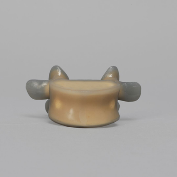 Lumbar L5, absolute™ 4th Gen. with 10 PCF Solid Foam Cancellous