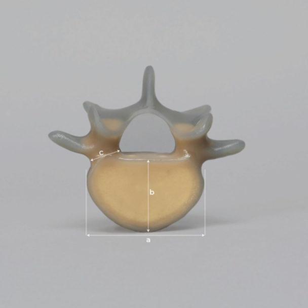 Lumbar L5, absolute™ 4th Gen. with 10 PCF Solid Foam Cancellous