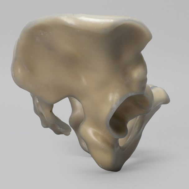Pelvis with Partial Fusion, absolute™ 4th Gen., 17 PCF Solid Foam Core, Large
