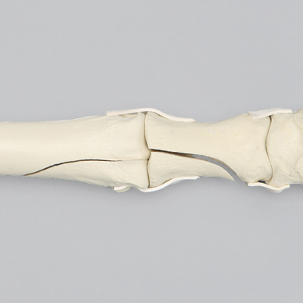 Equine Encased Distal Thoracic Limb with Carpal and Phalanx Fractures