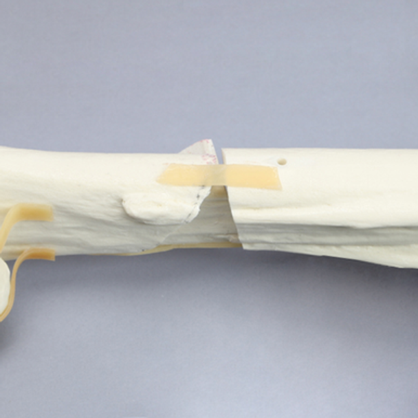 Equine Encased Distal Thoracic Limb with Metacarpal and Phalanx Fractures