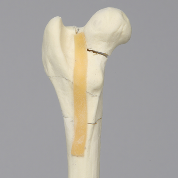 Canine Femur with Four-Part Comminuted Fracture