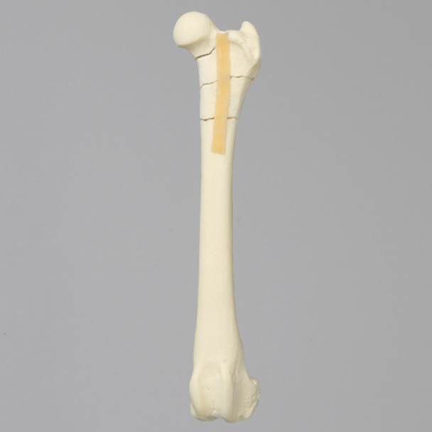 Canine Femur with Four-Part Comminuted Fracture
