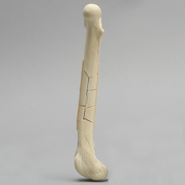 Canine Toy Breed Femur with Comminuted Midshaft Fracture
