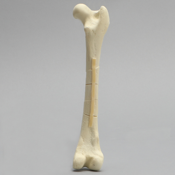 Canine Toy Breed Femur with Comminuted Midshaft Fracture
