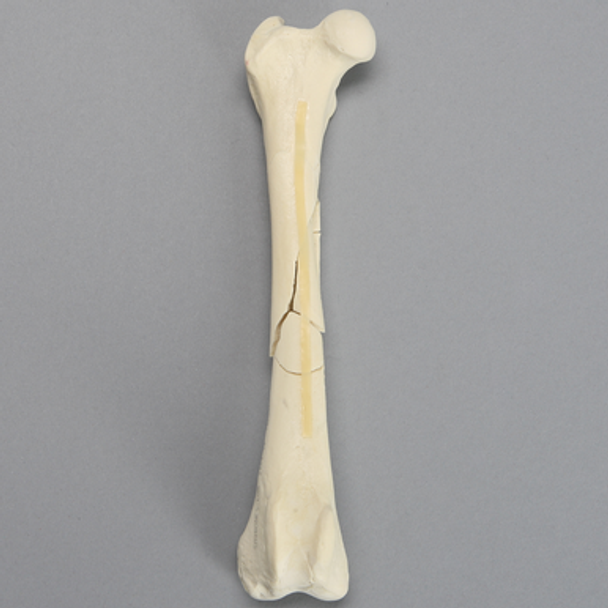 Canine Femur with Comminuted Fracture, Severe
