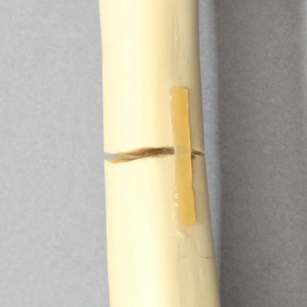 Canine Femur with Midshaft Transverse Fracture and Vise Attachment