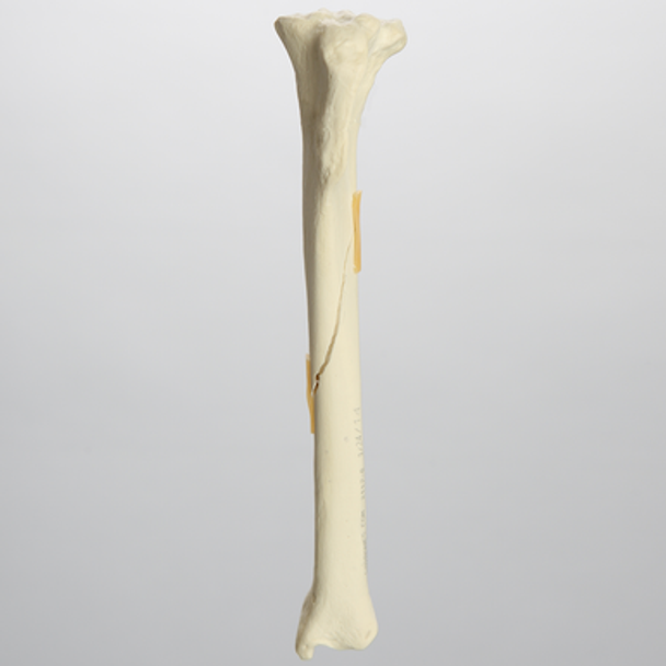 Canine Tibia with Spiral Fracture, Foam Cortical
