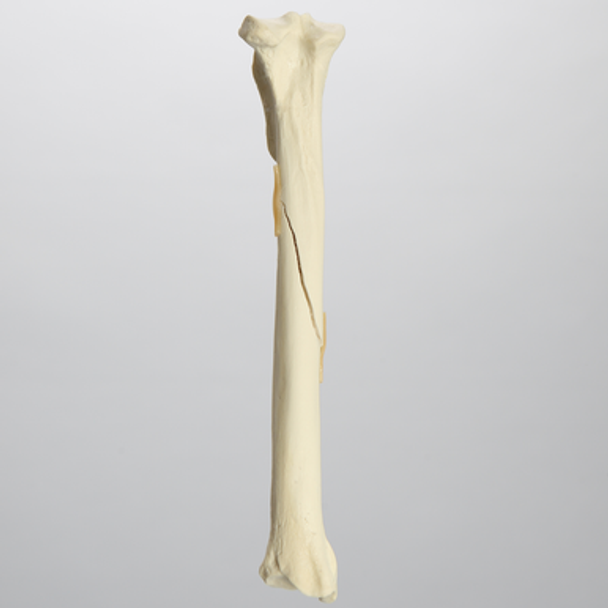 Canine Tibia with Spiral Fracture, Foam Cortical