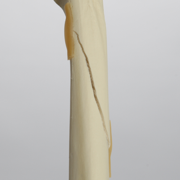 Canine Tibia with Spiral Fracture, Foam Cortical