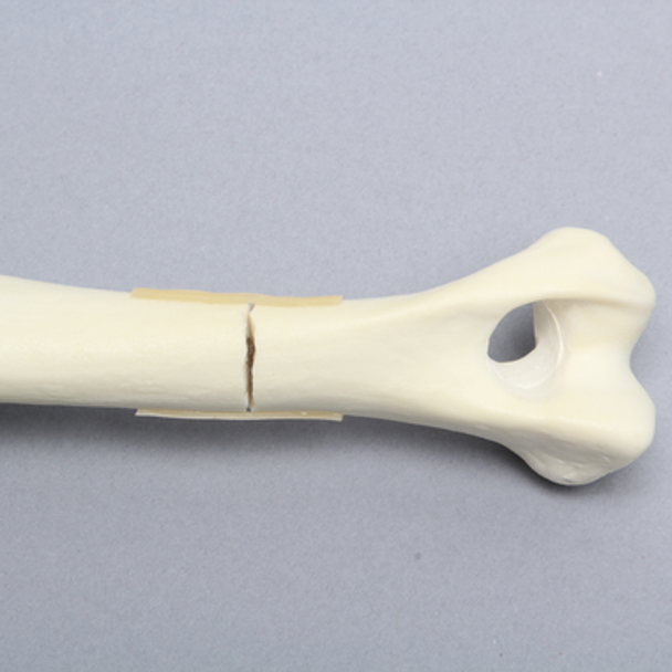 Canine Humerus with Distal Third Transverse Shaft Fracture, Solid Foam