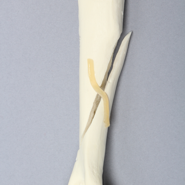 Canine Humerus with Long Oblique Fracture, Foam Cortical