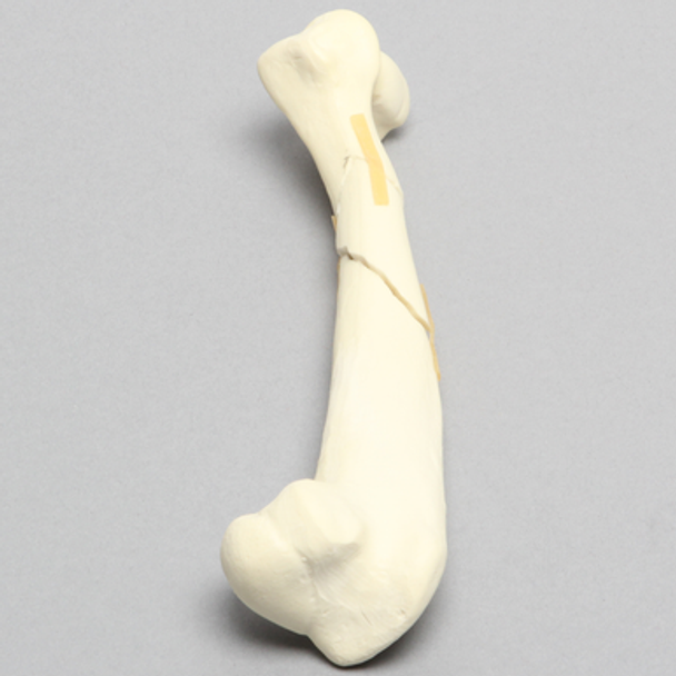 Canine Humerus with Distal Diaphyseal Butterfly Fracture, Foam Cortical