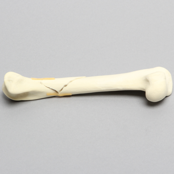 Canine Humerus with Distal Diaphyseal Butterfly Fracture, Foam Cortical