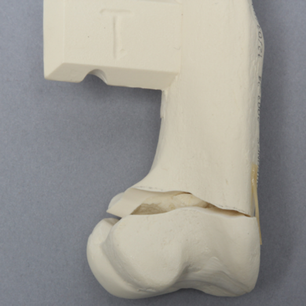 Canine Humerus with Multiple Fractures, Foam Cortical