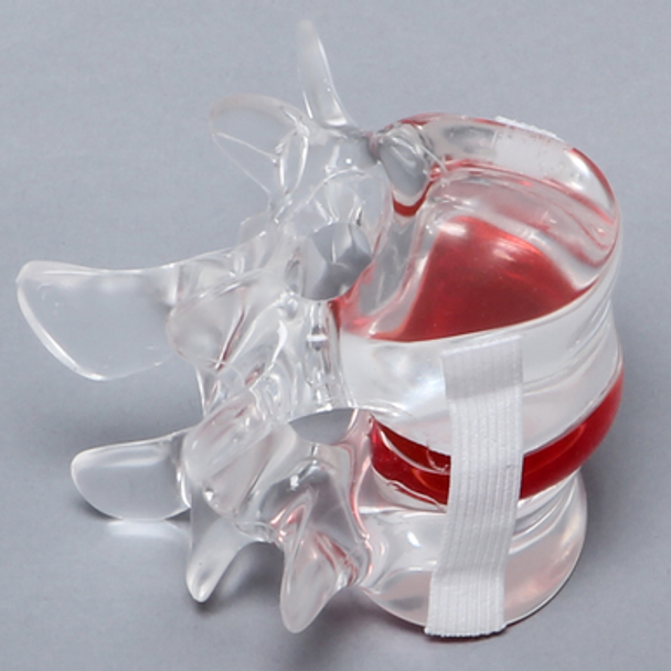 Lumbar Vertebrae L4-L5 with Gel-filled Nucleus, Solid Clear Plastic