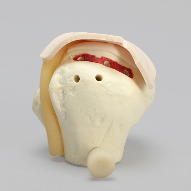 MagneFAST Humeral Head Insert