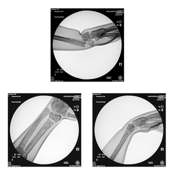 Colles Fracture Reduction and Casting Technique Trainer