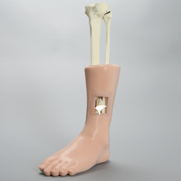 Foot and Ankle with Windows and Tibial and Fibular Fractures, Encased