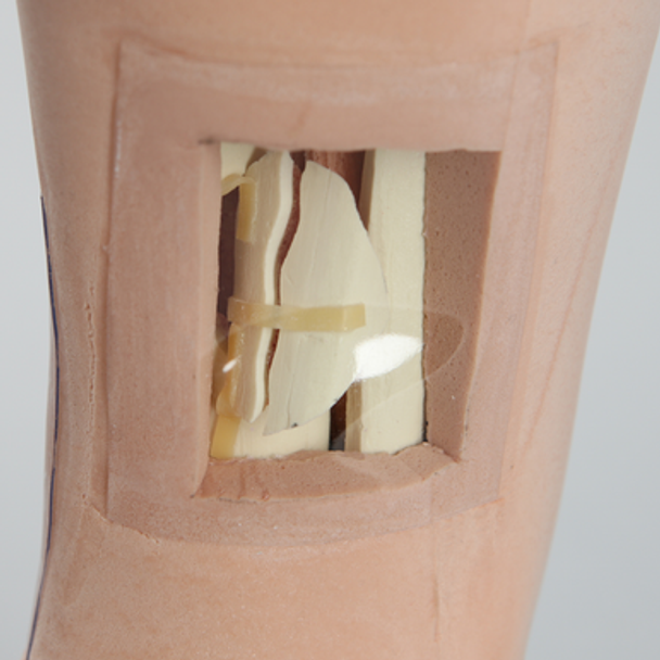 Foot and Ankle with Windows and Tibial and Fibular Fractures, Encased