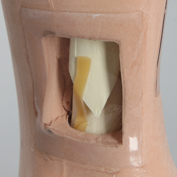 Foot and Ankle with Windows and Tibial and Fibular Fractures, Encased