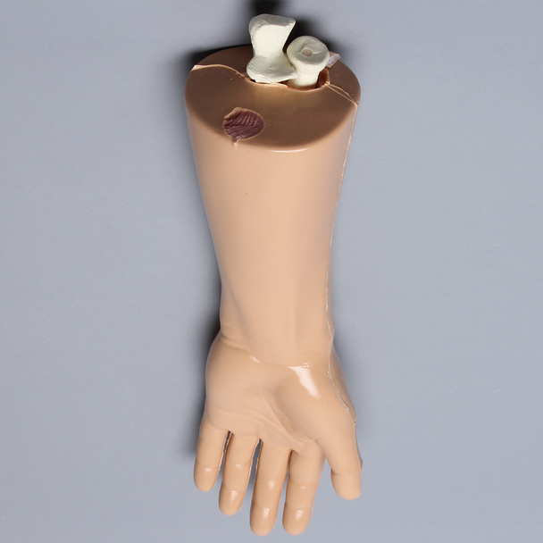 Wrist with Replaceable Fractured Radius, Encased