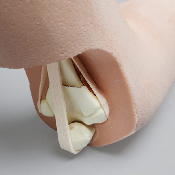 Pediatric Elbow with Supracondylar Fracture