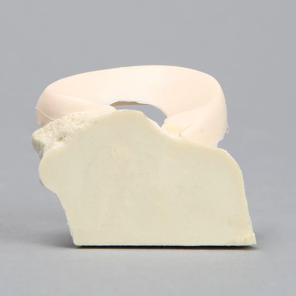 Meniscal Pad with Bone Block, Medial
