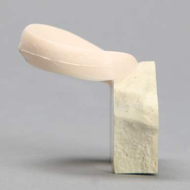 Meniscal Pad with Bone Block, Medial