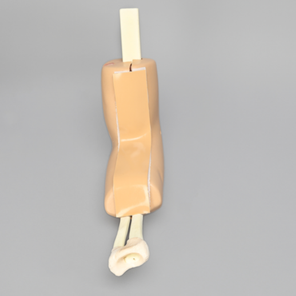 Arthroscopy Elbow with Reusable Portals