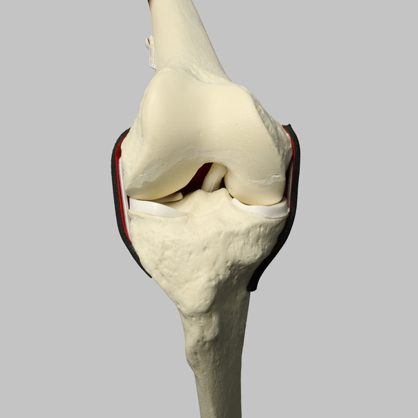 Knee Insert, Encapsulated ACL with Adjustable Ligament Knee Insert, Encapsulated ACL with Adjustable Ligament