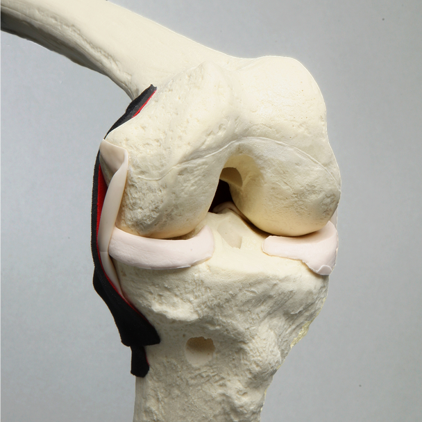 Knee, ACL with 3.2 mm/10 mm Step Tunnel , Solid Foam
