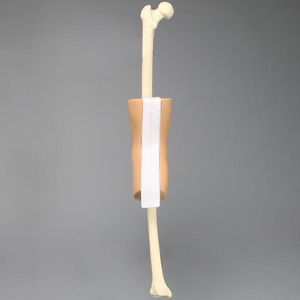 Knee, Encased with Incision Points