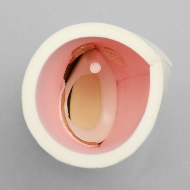 Glenoid Labrum Insert