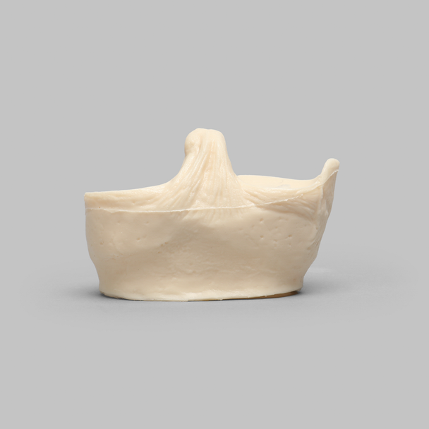 Meniscal Insert with Flap, Transverse, and Longitudinal Tears