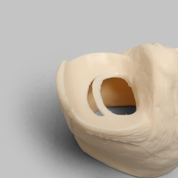 Meniscal Insert with Flap, Transverse, and Longitudinal Tears