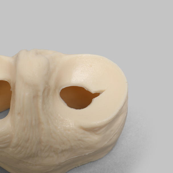 Meniscal Insert with Flap, Transverse, and Longitudinal Tears