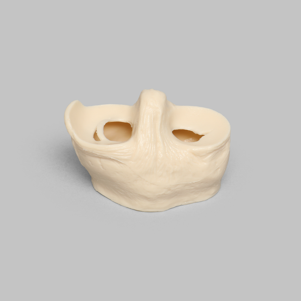 Meniscal Insert with Flap, Transverse, and Longitudinal Tears
