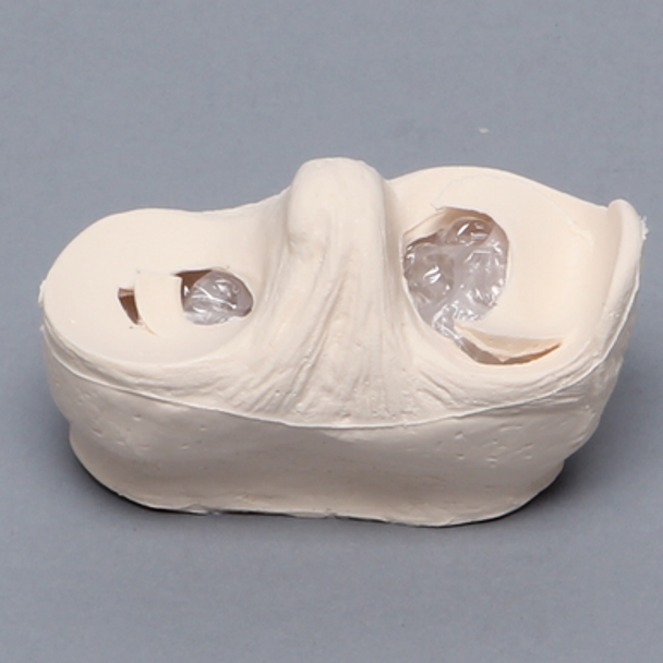 Meniscal Insert with Peripheral and Flap Tears
