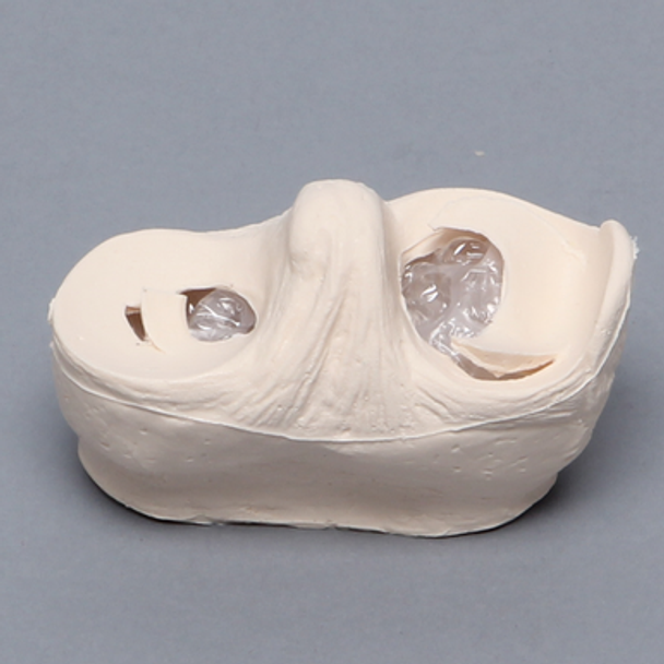 Meniscal Insert with Peripheral and Flap Tears