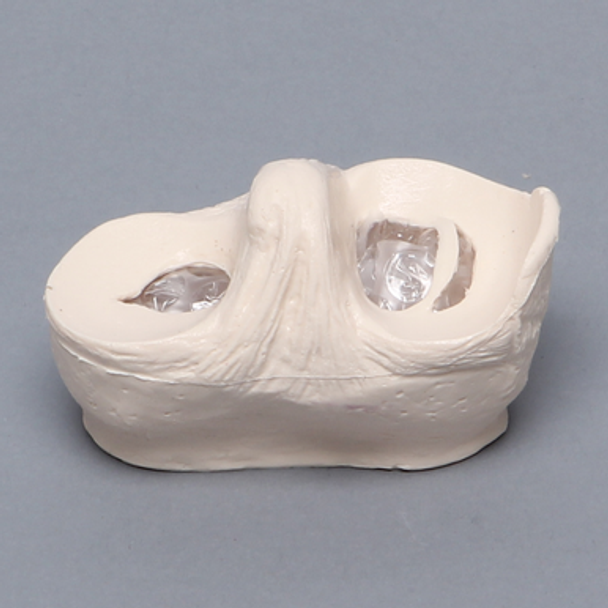 Meniscal Insert, includes Bucket-Handle Tear and Parrot-Beak Pathology