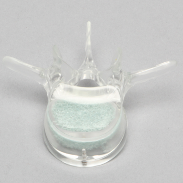 Vertebra L3 with Replaceable Cancellous Insert