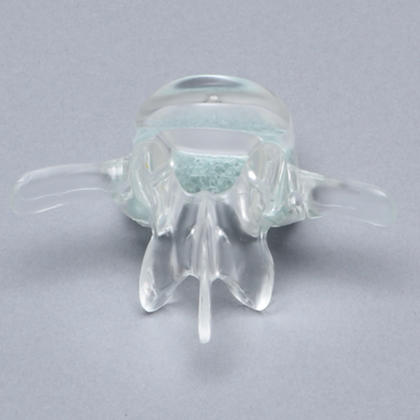 Vertebra L3 with Replaceable Cancellous Insert