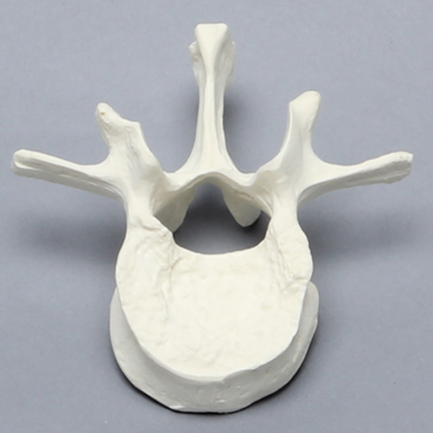 Vertebra, L1, Fractured, Solid Foam