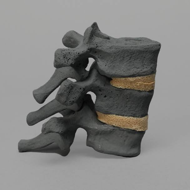 Thoracic, T10-T12, Osteoporotic Vertebrae