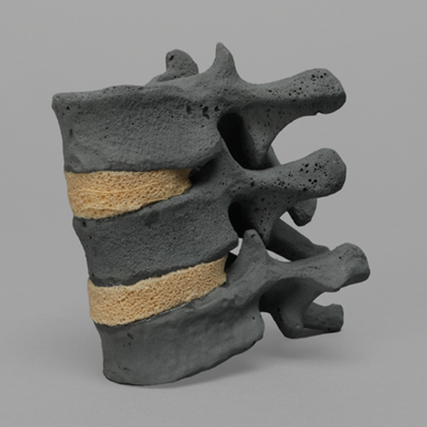 Thoracic, T10-T12, Osteoporotic Vertebrae