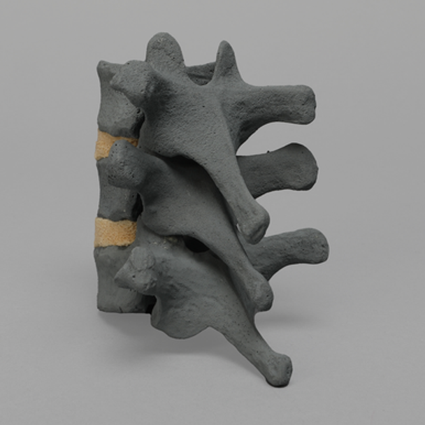 Thoracic, T10-T12, Osteoporotic Vertebrae